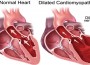 Scompenso cardiaco